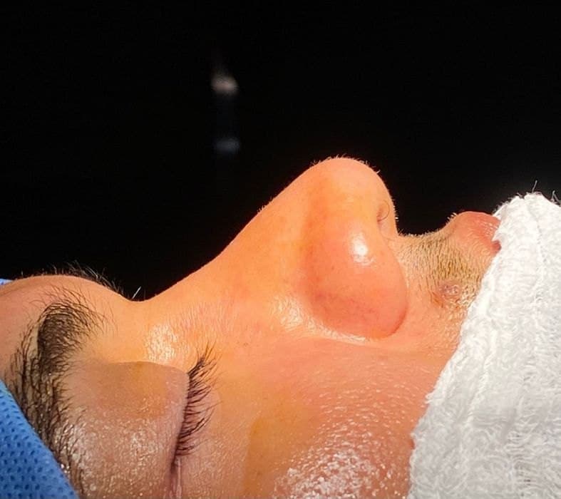 Antes: Perfil nasal antes y después de rinoplastia