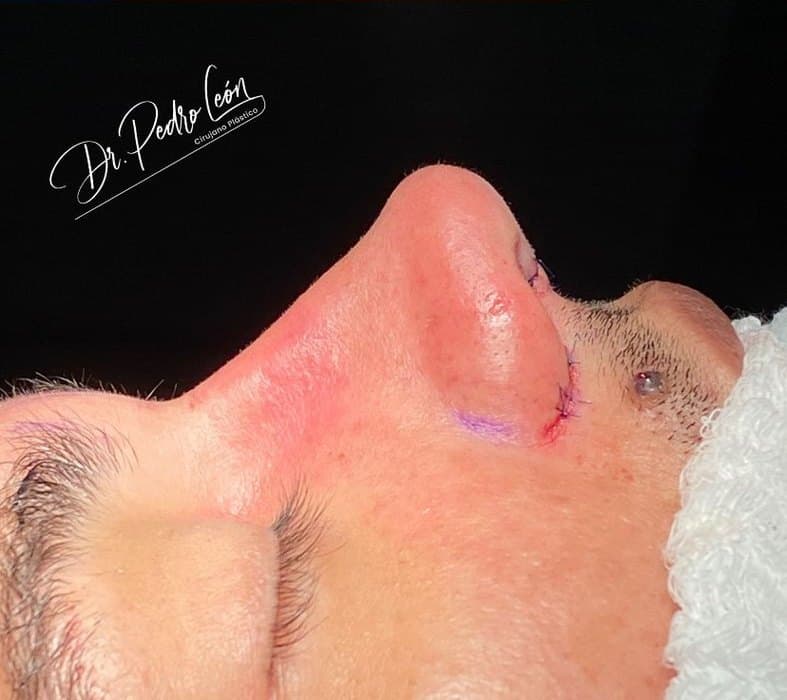 Después: Perfil nasal antes y después de rinoplastia
