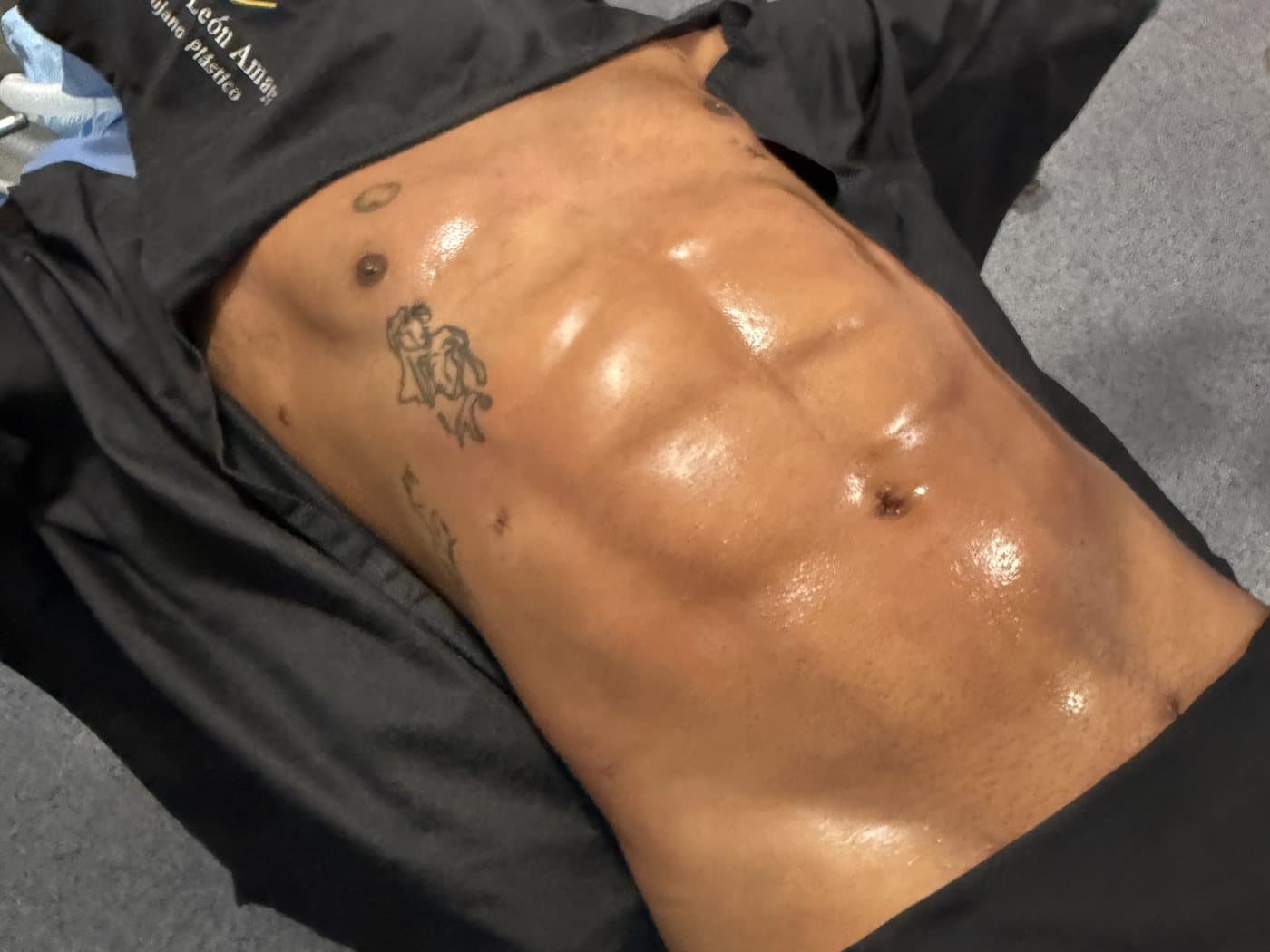 Abdomen masculino con definición muscular tras liposucción HD