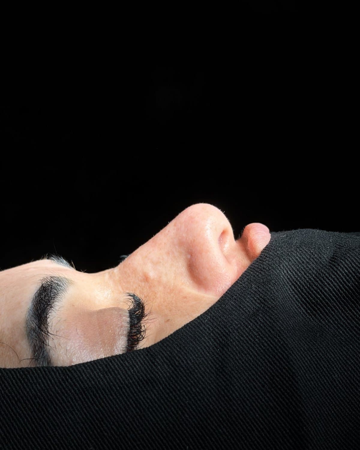 Perfil nasal de una paciente tras rinoplastia ultrasónica