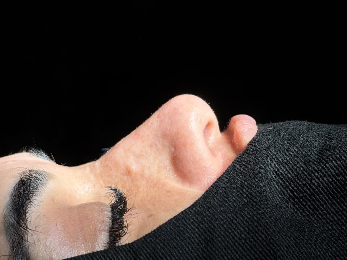 Perfil nasal de una paciente tras rinoplastia ultrasónica